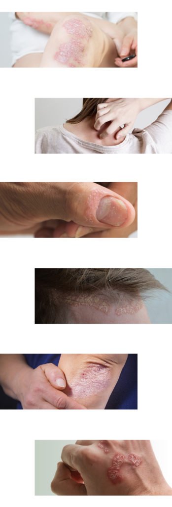 Ayurvedic treatment for psoriasis in Chennai | Chennai Natural Treatment Clinic